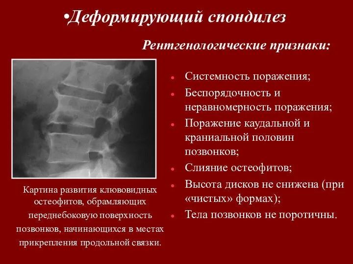 Системность поражения; Беспорядочность и неравномерность поражения; Поражение каудальной и краниальной