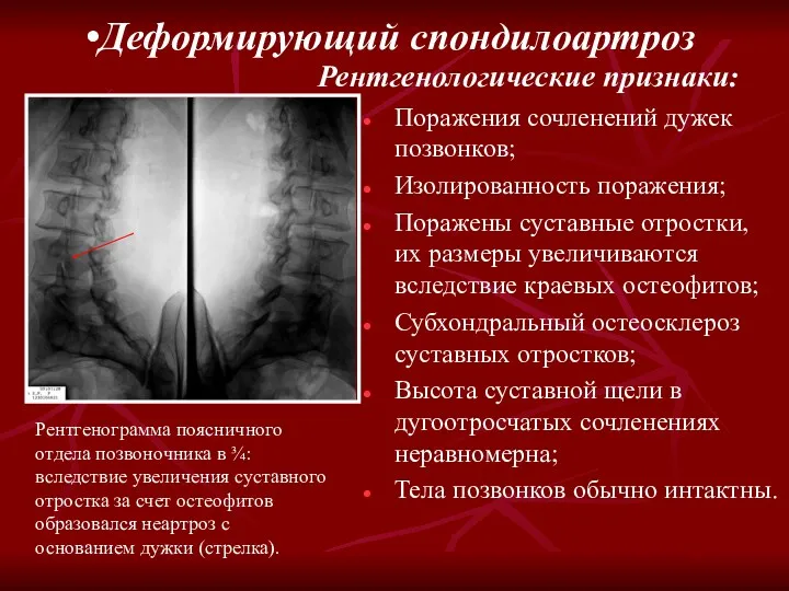 Поражения сочленений дужек позвонков; Изолированность поражения; Поражены суставные отростки, их