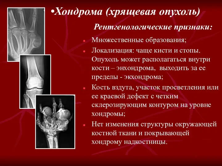 Хондрома (хрящевая опухоль) Рентгенологические признаки: Множественные образования; Локализация: чаще кисти