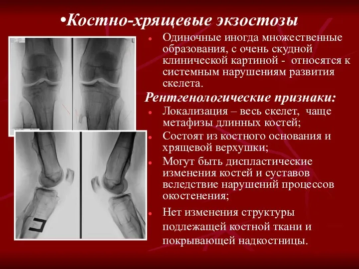 Костно-хрящевые экзостозы Рентгенологические признаки: Одиночные иногда множественные образования, с очень