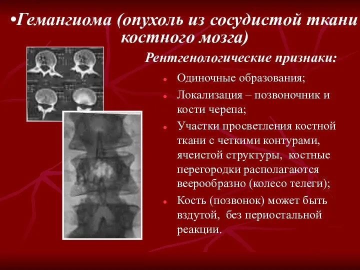 Гемангиома (опухоль из сосудистой ткани костного мозга) Рентгенологические признаки: Одиночные