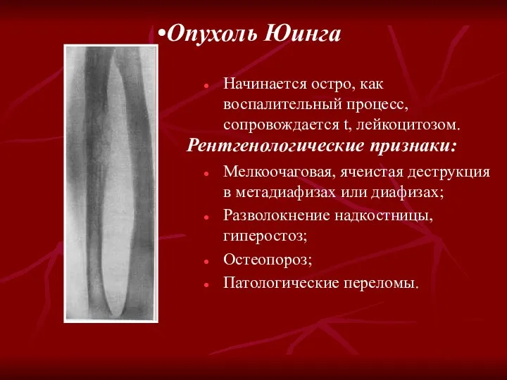 Опухоль Юинга Рентгенологические признаки: Начинается остро, как воспалительный процесс, сопровождается