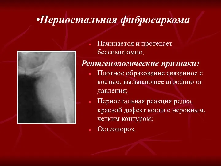 Периостальная фибросаркома Рентгенологические признаки: Начинается и протекает бессимптомно. Плотное образование