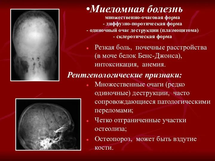 Миеломная болезнь Рентгенологические признаки: Резкая боль, почечные расстройства (в моче