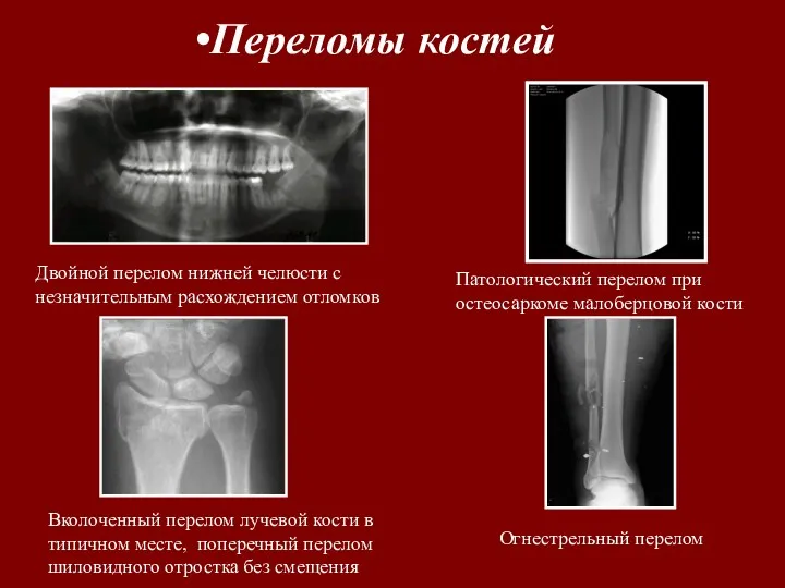 Переломы костей Двойной перелом нижней челюсти с незначительным расхождением отломков