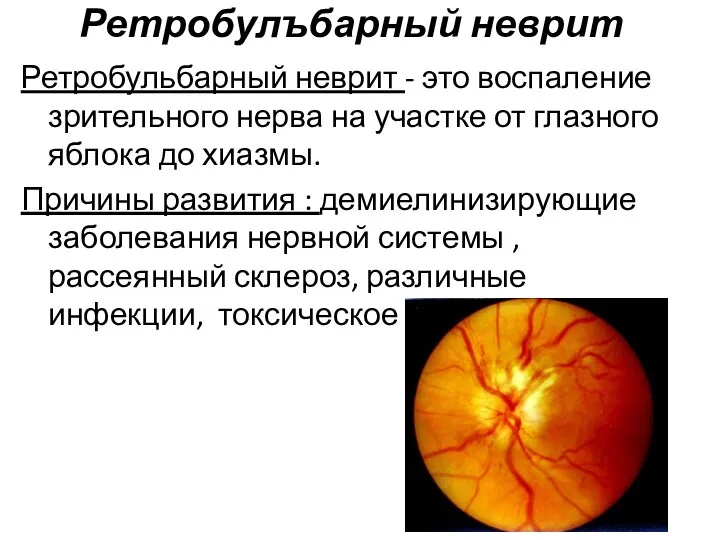 Ретробулъбарный неврит Ретробульбарный неврит - это воспаление зрительного нерва на