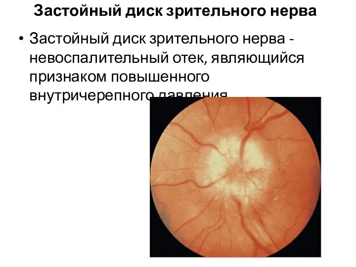 Застойный диск зрительного нерва Застойный диск зрительного нерва - невоспалительный отек, являющийся признаком повышенного внутричерепного давления.