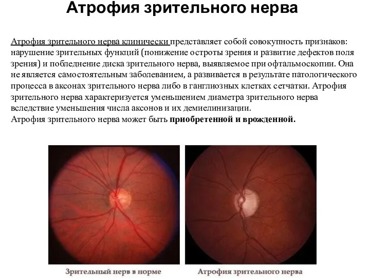 Атрофия зрительного нерва Атрофия зрительного нерва клинически представляет собой совокупность