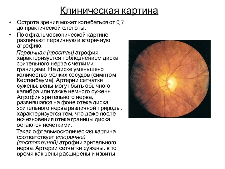 Клиническая картина Острота зрения может колебаться от 0,7 до практической