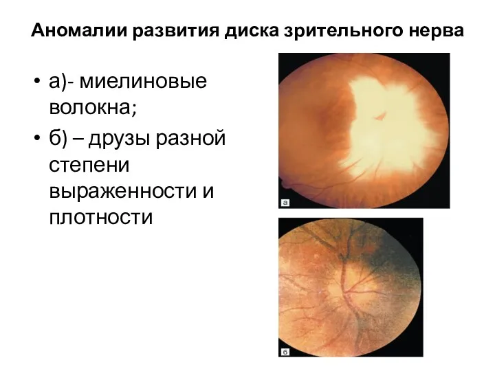 Аномалии развития диска зрительного нерва а)- миелиновые волокна; б) – друзы разной степени выраженности и плотности