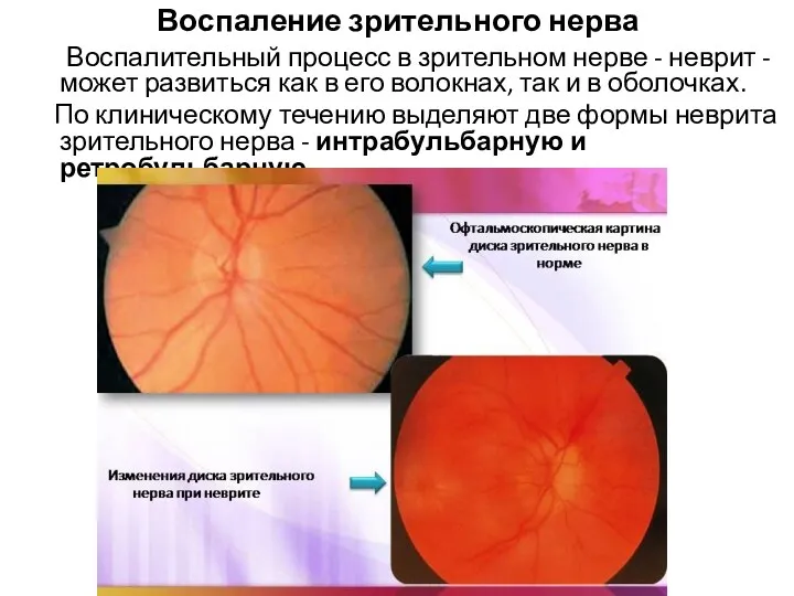 Воспаление зрительного нерва Воспалительный процесс в зрительном нерве - неврит