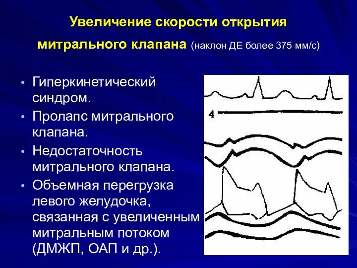 Увеличение скорости открытия митрального клапана (наклон ДЕ более 375 мм/с)