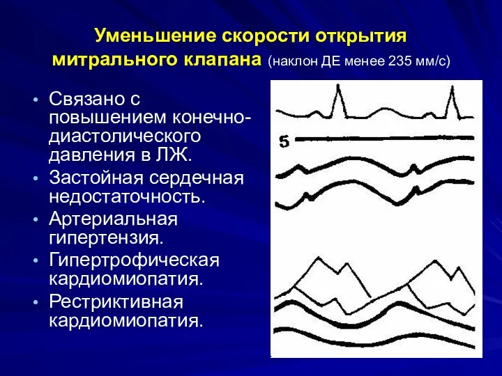 Уменьшение скорости открытия митрального клапана (наклон ДЕ менее 235 мм/с)