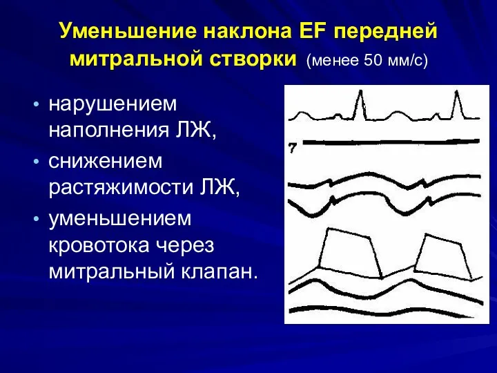 Уменьшение наклона EF передней митральной створки (менее 50 мм/с) нарушением