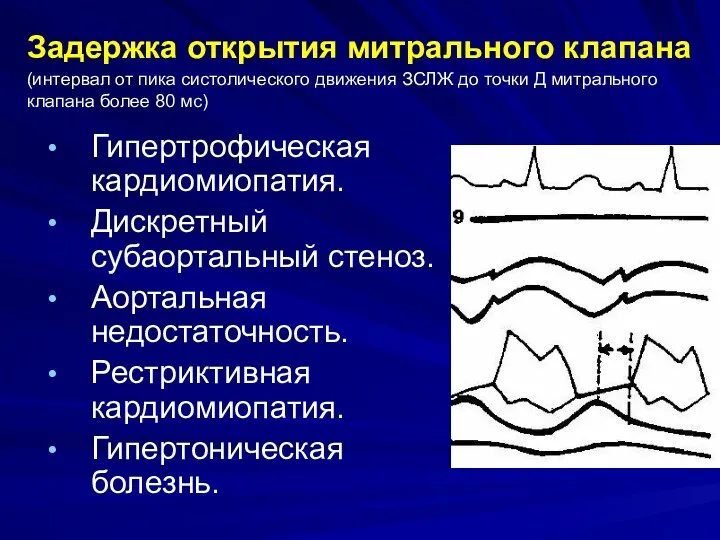 Задержка открытия митрального клапана (интервал от пика систолического движения ЗСЛЖ