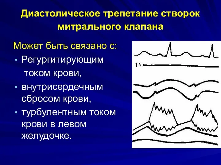 Диастолическое трепетание створок митрального клапана Может быть связано с: Регургитирующим