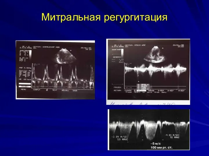 Митральная регургитация