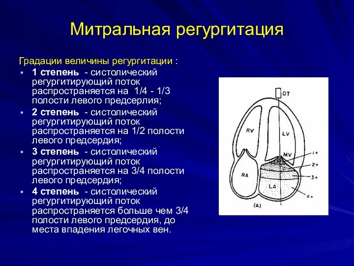 Митральная регургитация Градации величины регургитации : 1 степень - систолический