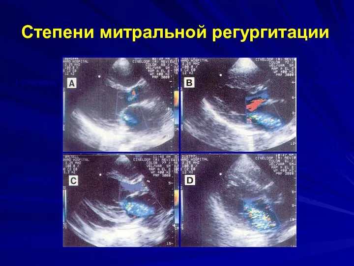 Степени митральной регургитации 1 степень 2 степень 2 степень 3 – 4 степень