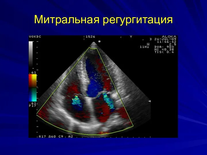 Митральная регургитация