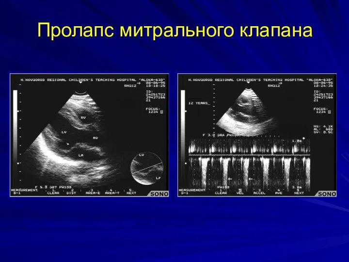 Пролапс митрального клапана Провисание створки МК Регургитация на МК