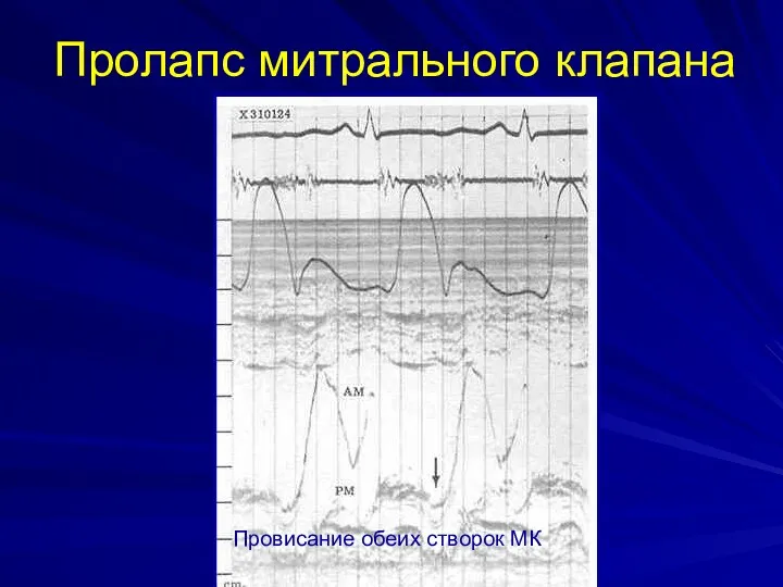 Пролапс митрального клапана Провисание обеих створок МК