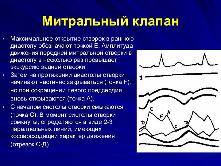 Митральный клапан Максимальное открытие створок в раннюю диастолу обозначают точкой