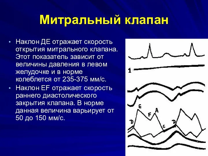 Митральный клапан Наклон ДЕ отражает скорость открытия митрального клапана. Этот