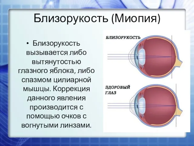 Близорукость (Миопия) Близорукость вызывается либо вытянутостью глазного яблока, либо спазмом цилиарной мышцы. Коррекция