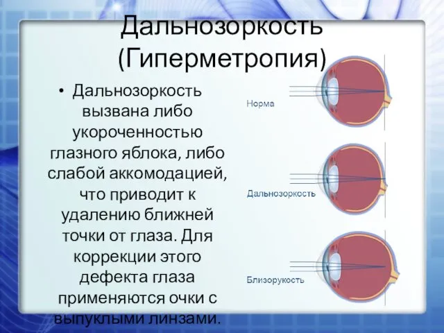 Дальнозоркость (Гиперметропия) Дальнозоркость вызвана либо укороченностью глазного яблока, либо слабой