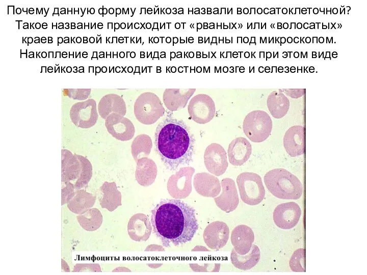 Почему данную форму лейкоза назвали волосатоклеточной? Такое название происходит от