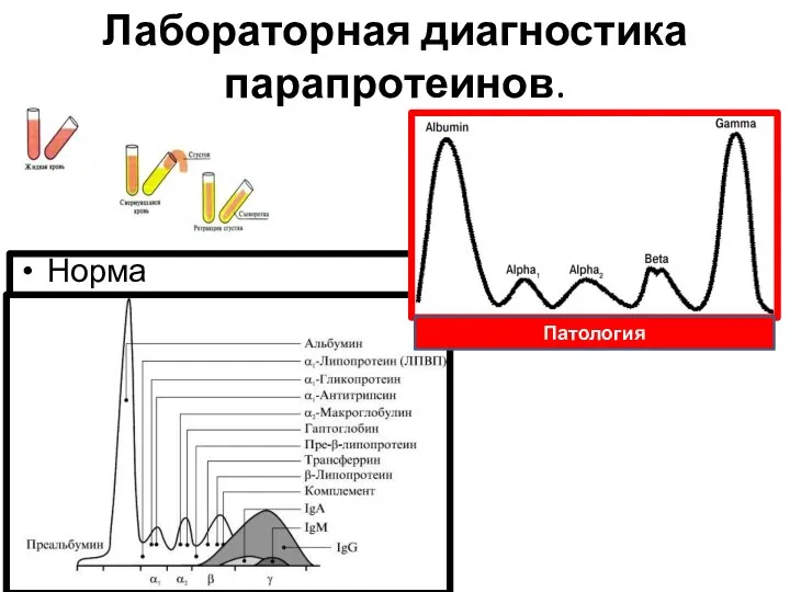 Лабораторная диагностика парапротеинов. Норма Патология