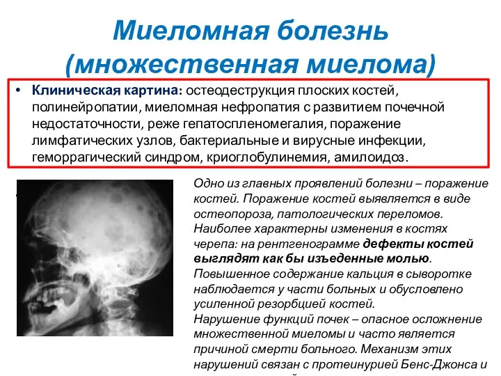 Миеломная болезнь (множественная миелома) Клиническая картина: остеодеструкция плоских костей, полинейропатии,