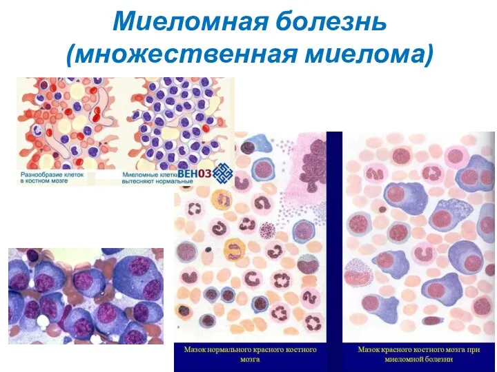 Миеломная болезнь (множественная миелома)