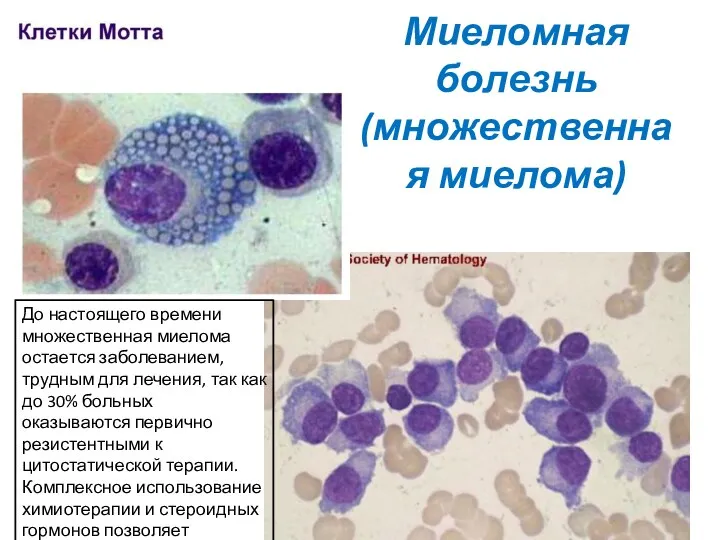 Миеломная болезнь (множественная миелома) До настоящего времени множественная миелома остается