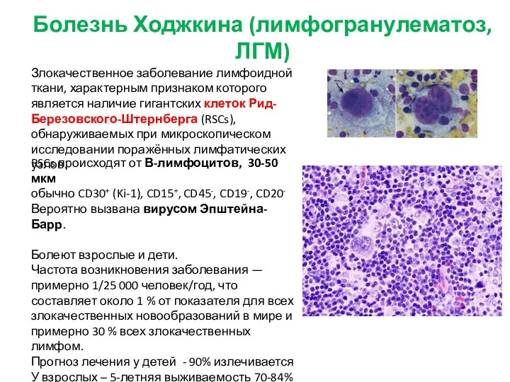 Болезнь Ходжкина (лимфогранулематоз, ЛГМ) Злокачественное заболевание лимфоидной ткани, характерным признаком