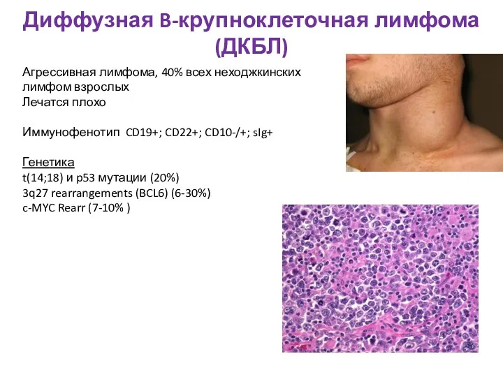 Диффузная B-крупноклеточная лимфома (ДКБЛ) Агрессивная лимфома, 40% всех неходжкинских лимфом