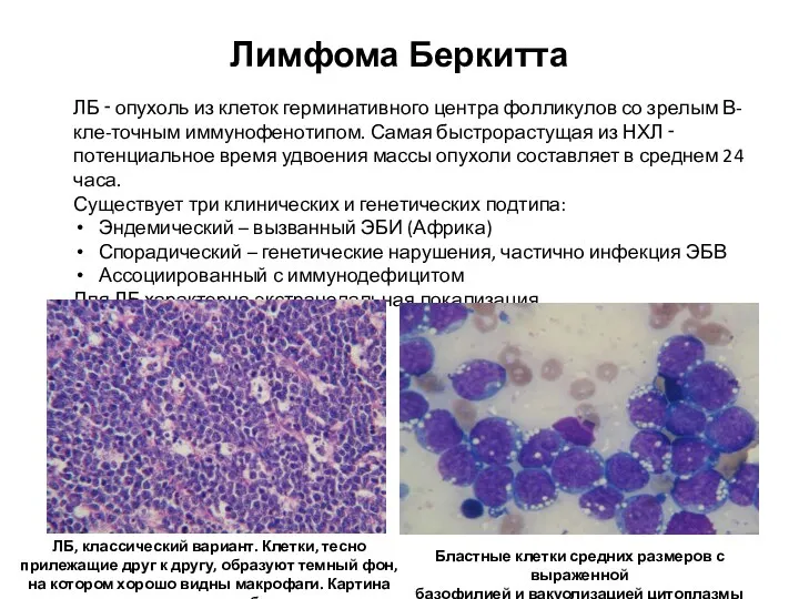 Лимфома Беркитта ЛБ ‑ опухоль из клеток герминативного центра фолликулов