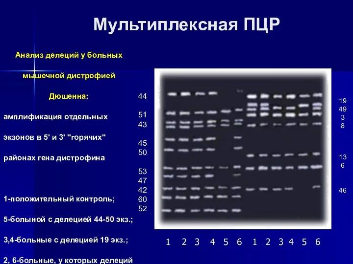 Мультиплексная ПЦР Анализ делеций у больных мышечной дистрофией Дюшенна: амплификация