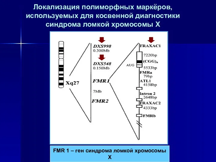 Локализация полиморфных маркёров, используемых для косвенной диагностики синдрома ломкой хромосомы