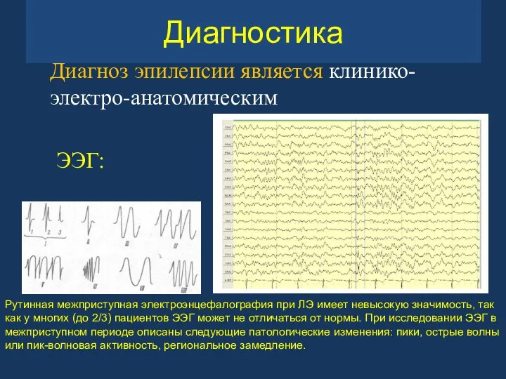 Диагностика Диагноз эпилепсии является клинико-электро-анатомическим ЭЭГ: Рутинная межприступная электроэнцефалография при