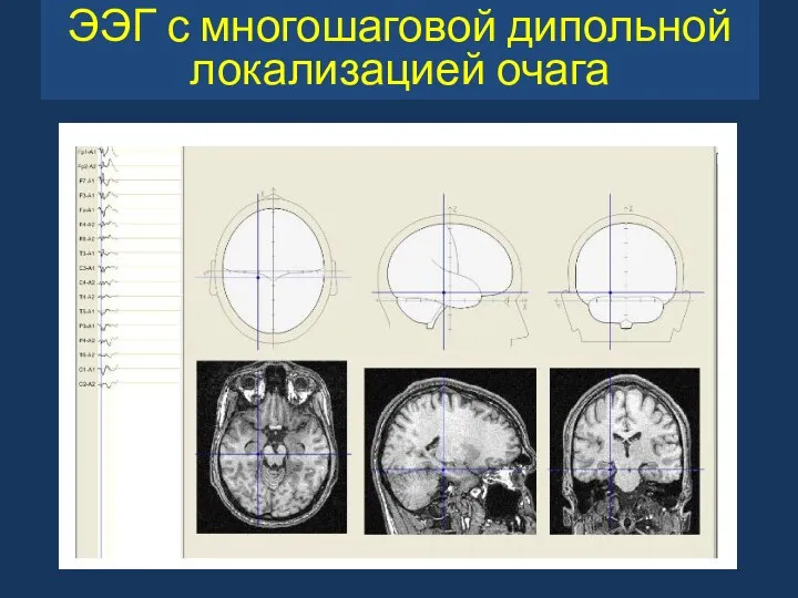 ЭЭГ с многошаговой дипольной локализацией очага