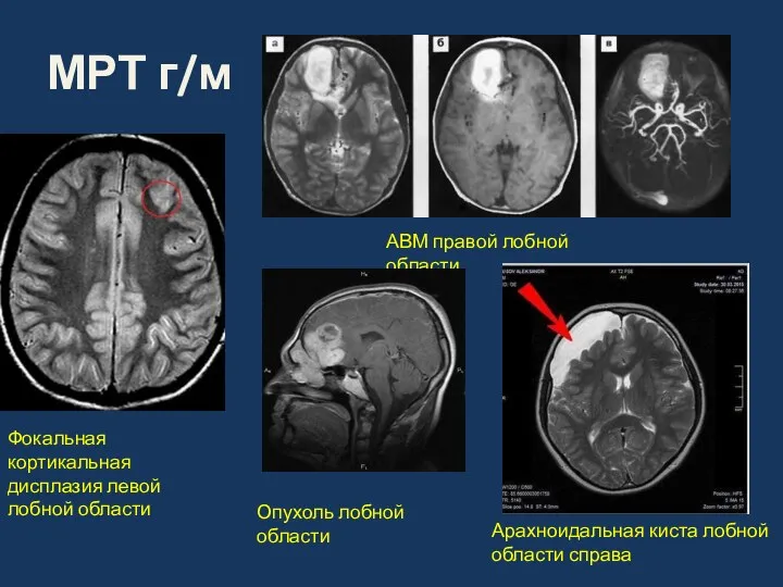 МРТ г/м Фокальная кортикальная дисплазия левой лобной области АВМ правой