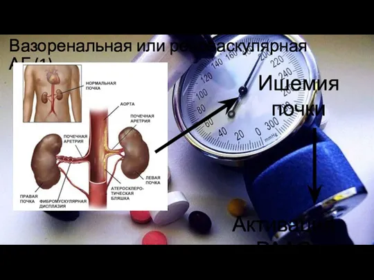 Вазоренальная или реноваскулярная АГ (1) Ишемия почки Активация РААС