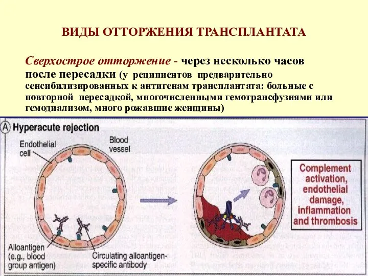 ВИДЫ ОТТОРЖЕНИЯ ТРАНСПЛАНТАТА Сверхострое отторжение - через несколько часов после