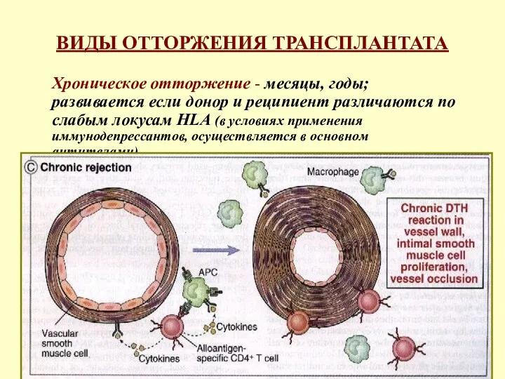 ВИДЫ ОТТОРЖЕНИЯ ТРАНСПЛАНТАТА Хроническое отторжение - месяцы, годы; развивается если