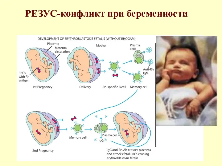 РЕЗУС-конфликт при беременности