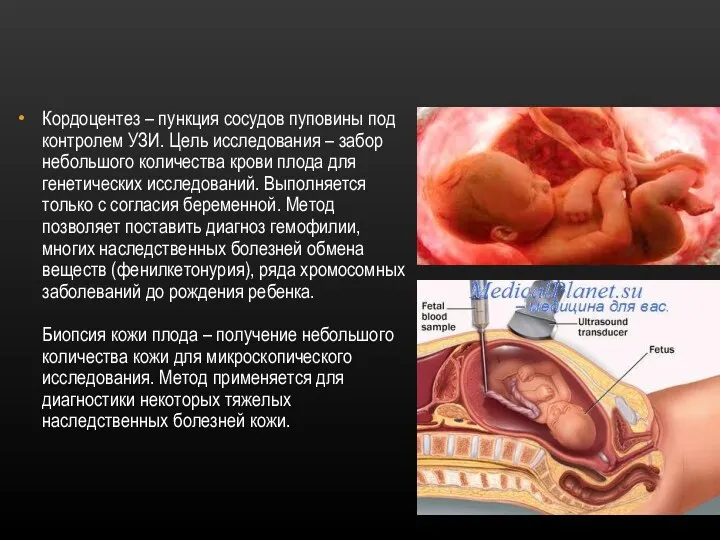 Кордоцентез – пункция сосудов пуповины под контролем УЗИ. Цель исследования