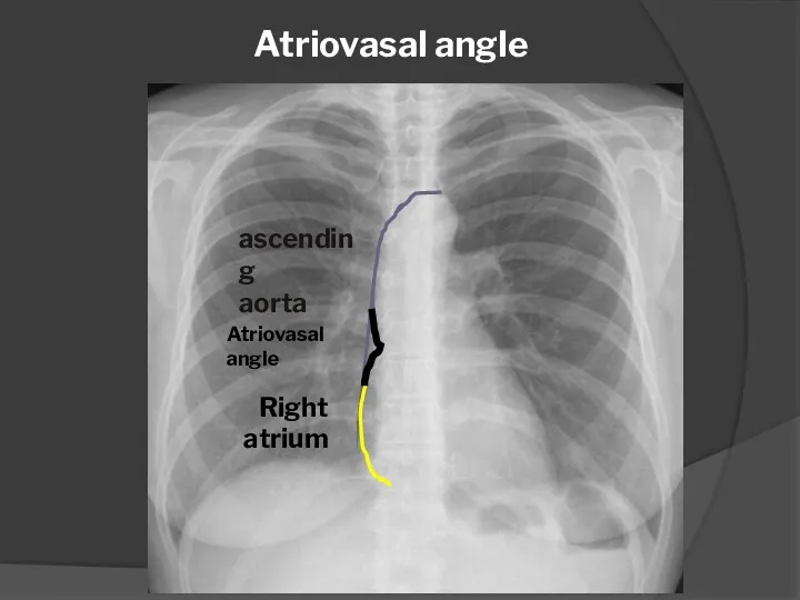 Atriovasal angle ascending aorta Right atrium Atriovasal angle