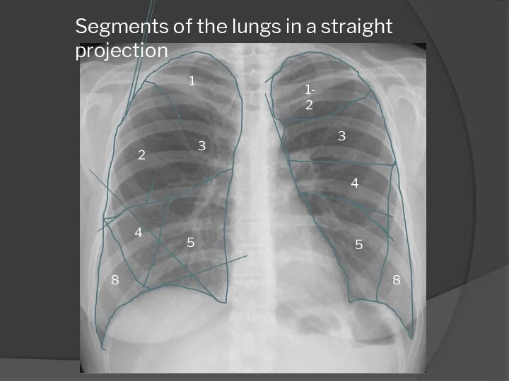 1 2 3 4 5 8 Segments of the lungs in a straight